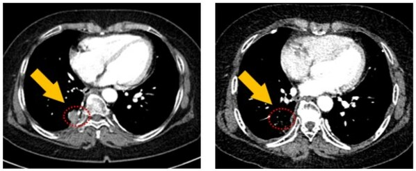 Lung CT scan image, right lower lobe tumor lesion 21mm -> 10mm, tumor size reduced by 52.4%